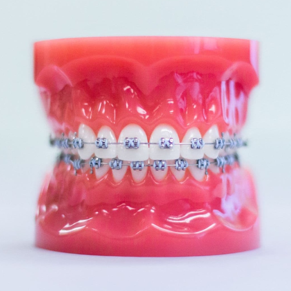 plastic model wearing metal braces